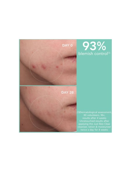 Apivita Anti-Acne Lotion Just Bee Clear for Oily Skin 200ml