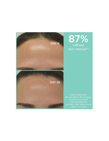 Apivita Anti-Acne Lotion Just Bee Clear for...