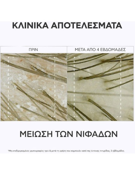Apivita Dandruff Relief Severe Dandruff Δερματολογικό Σαμπουάν Για Εντονη Πυτιρίδα Κατά του Κνησμού & Επανεμφάνισης 125mL